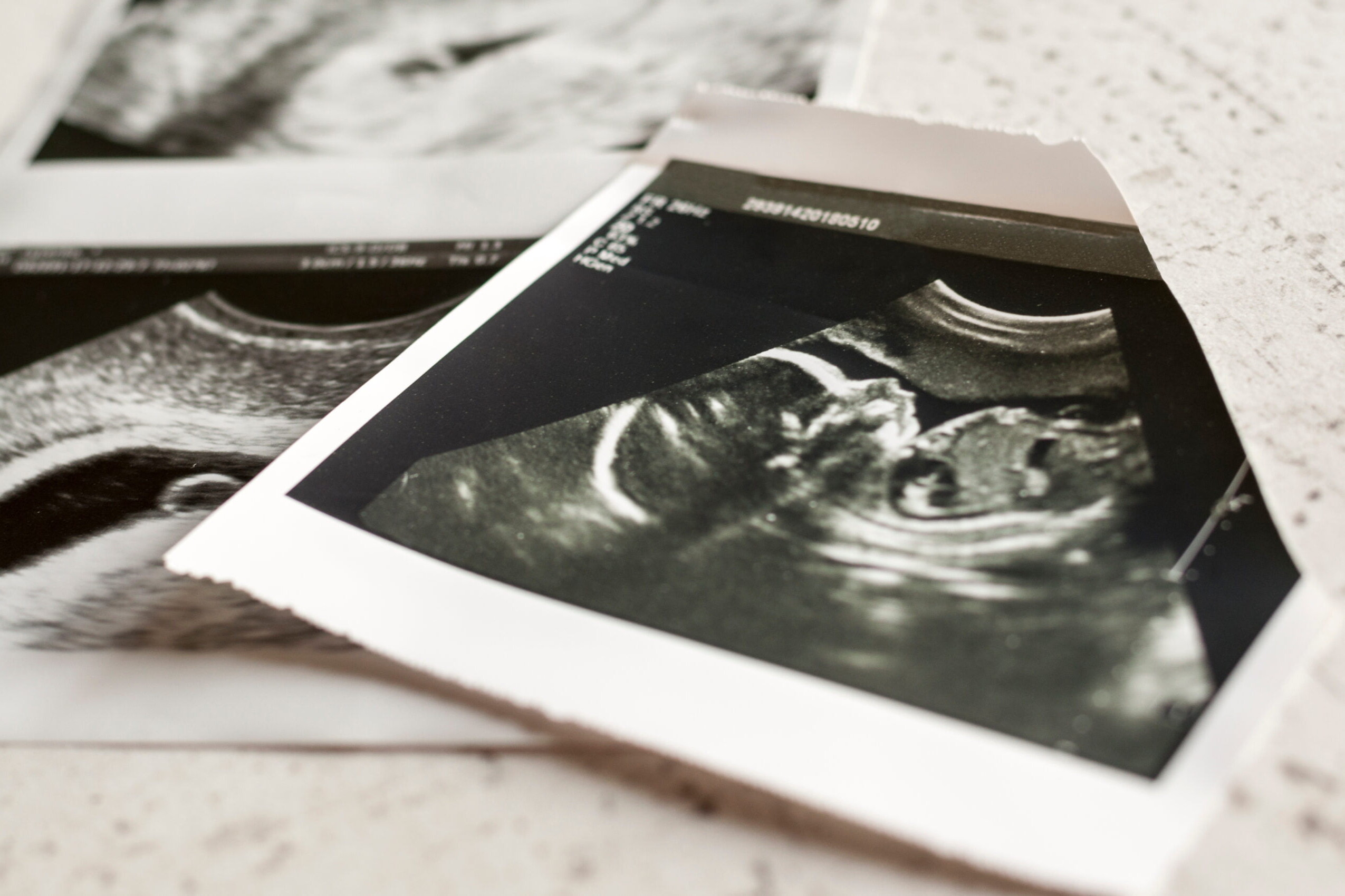 bezpłatne badania prenatalne w Gliwicach